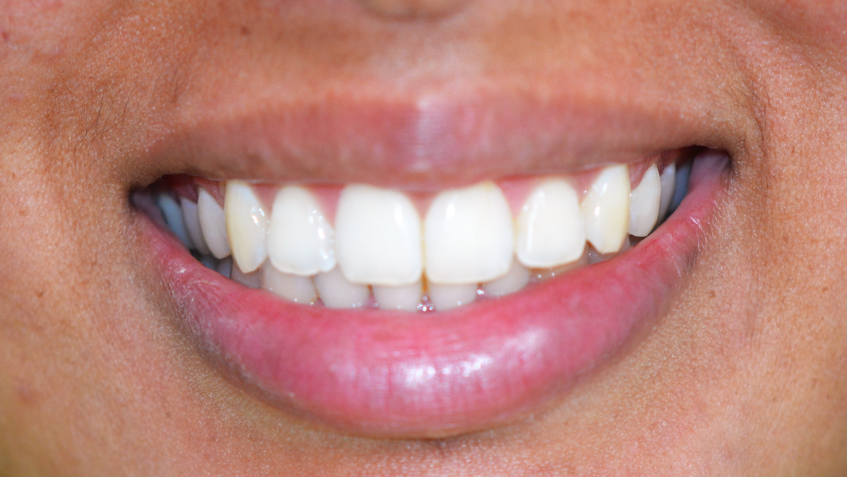 sourire nivelé